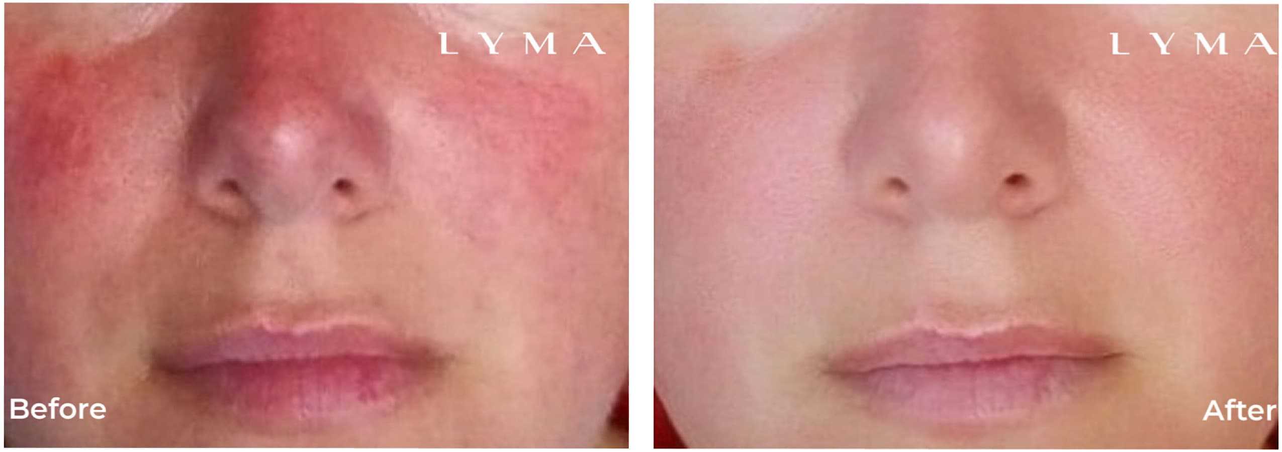 Before and after photos of subject with rosacea treated with the LYMA Laser.