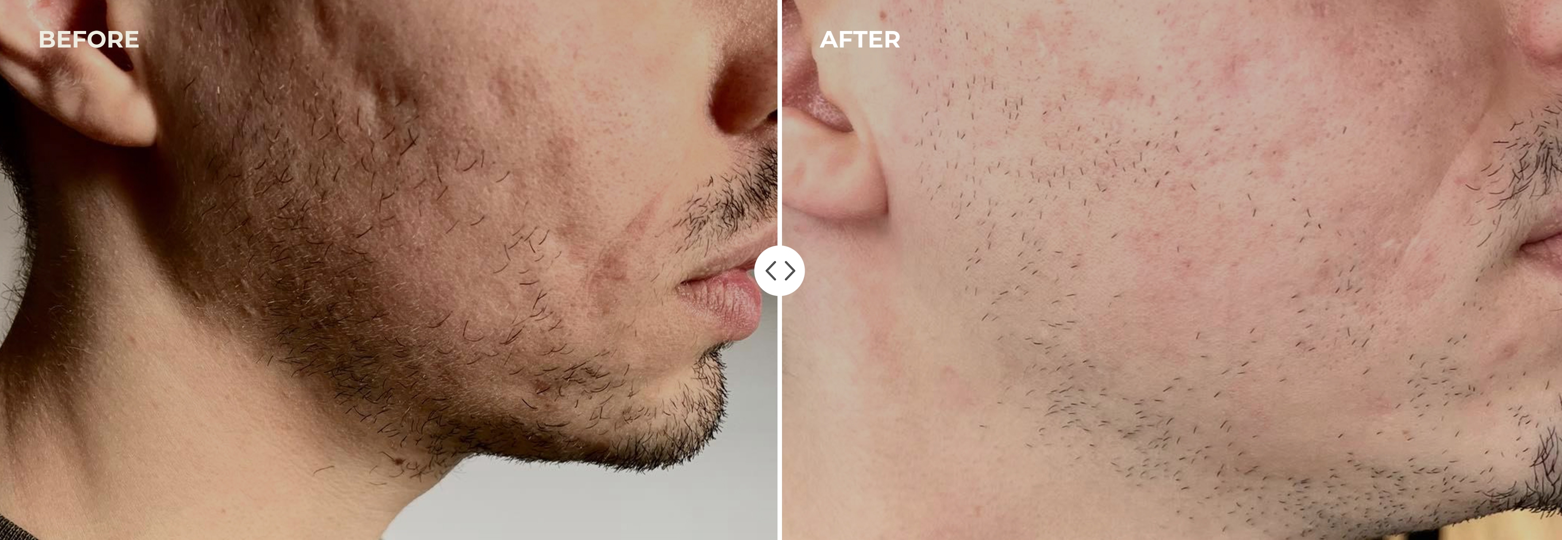 Before and After laser treatment of face scar