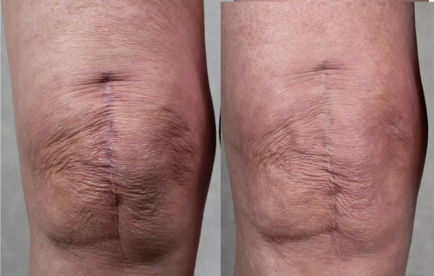 LYMA knee scar before after