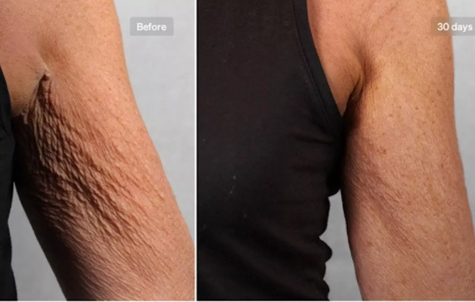 LYMA Laser PRO Before and after of saggy skin under arms