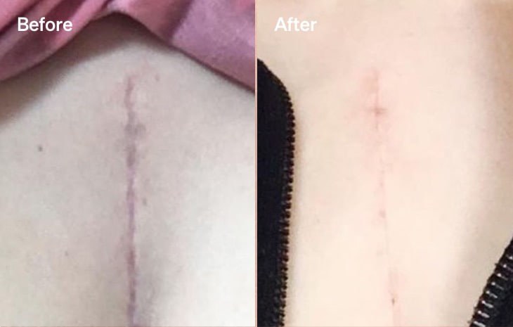 LYMA scar chest before after