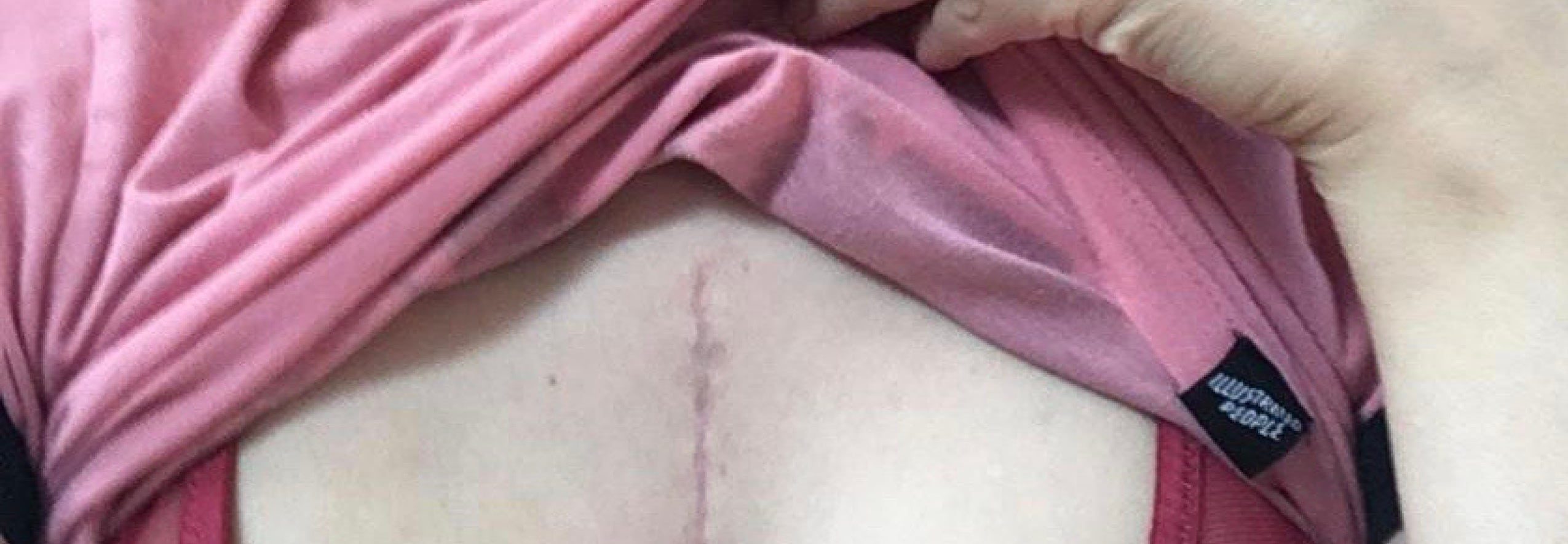 Surgical scar keloid