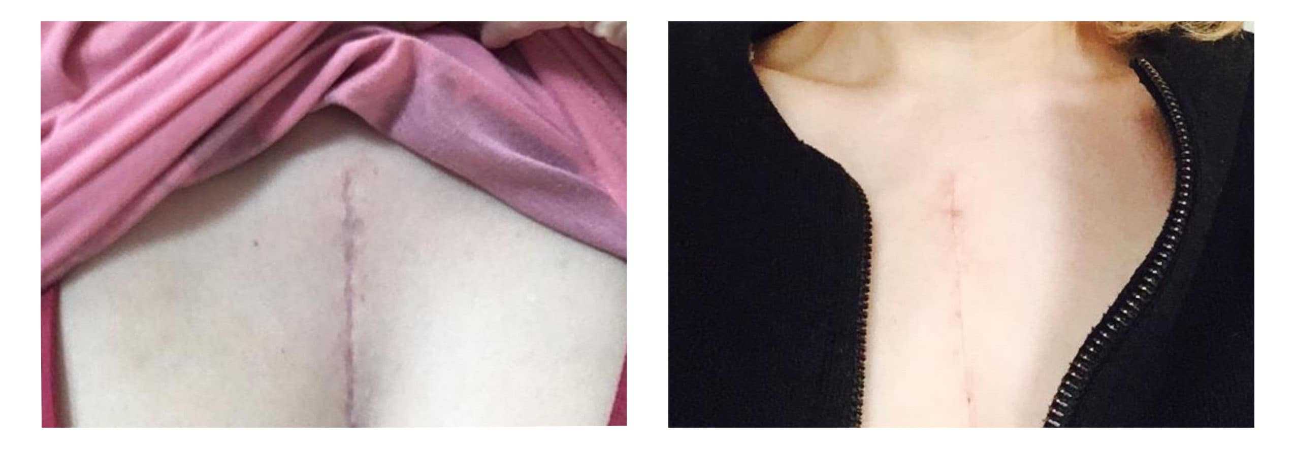 Chest scar before after