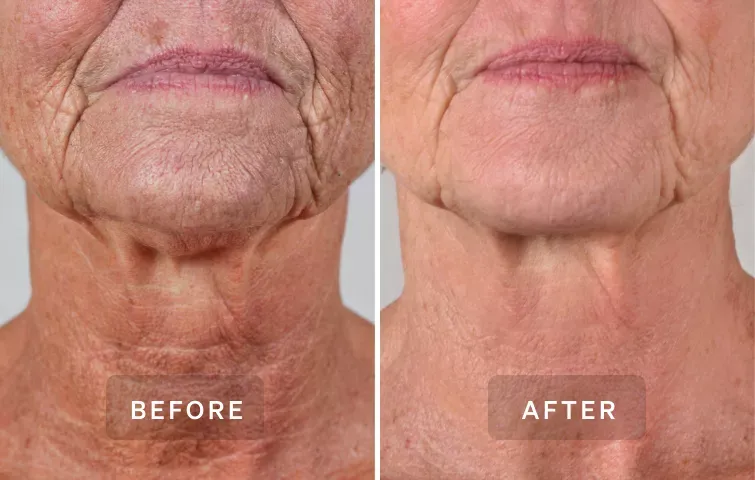 Anti-aging LYMA Laser PRO before and after