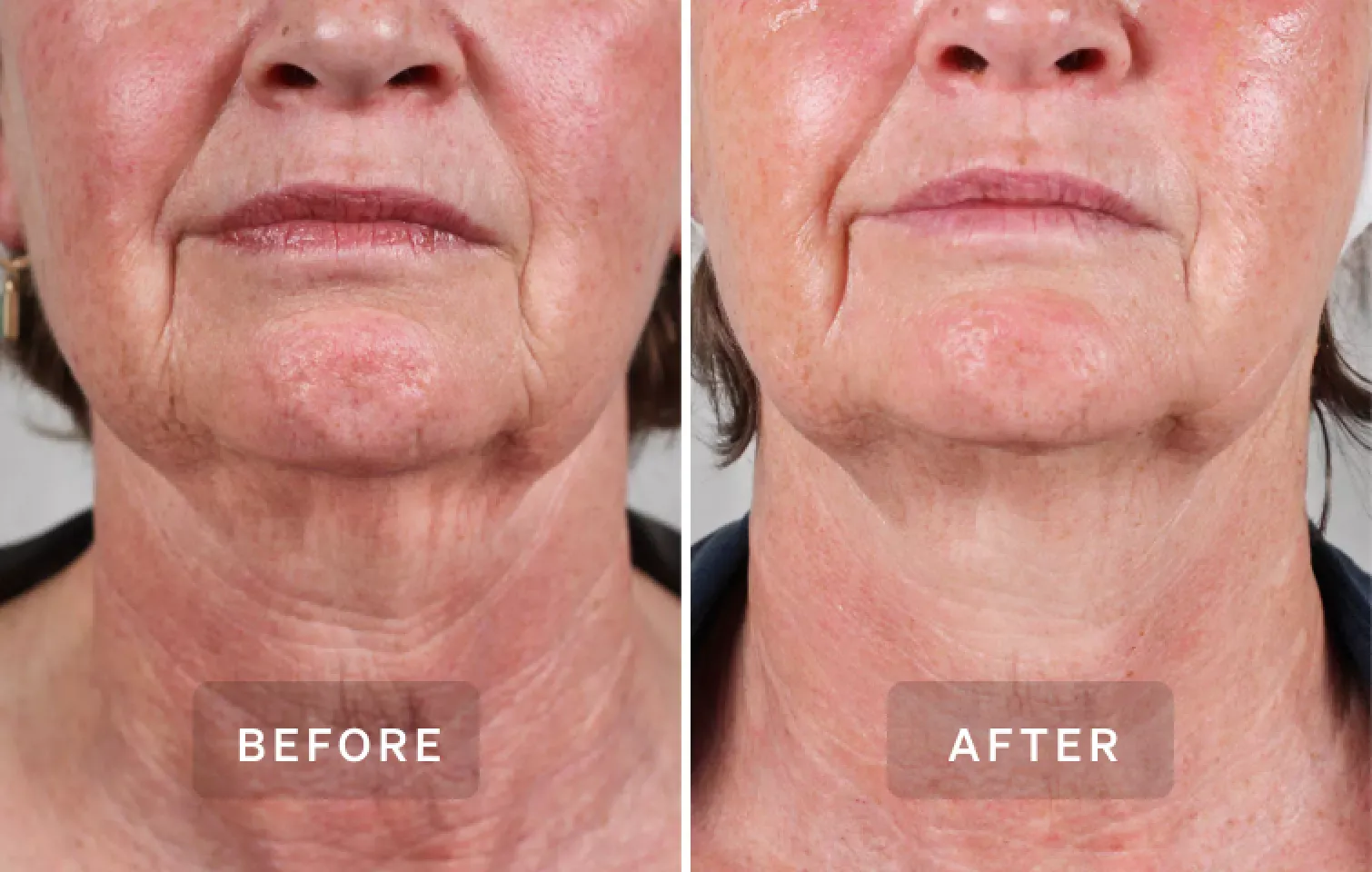 Before and after image of neck wrinkles treated by the LYMA Laser PRO
