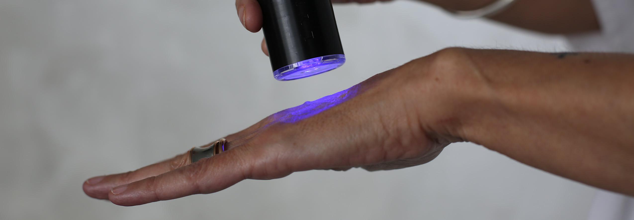 Hand skin laser skin tightening