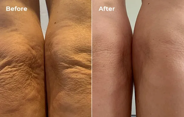 Before and after photo of sagging skin on knees