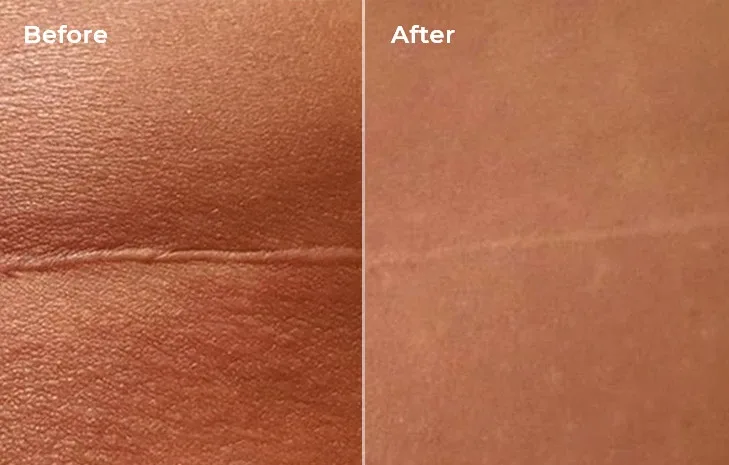 Lyma laser scar before after
