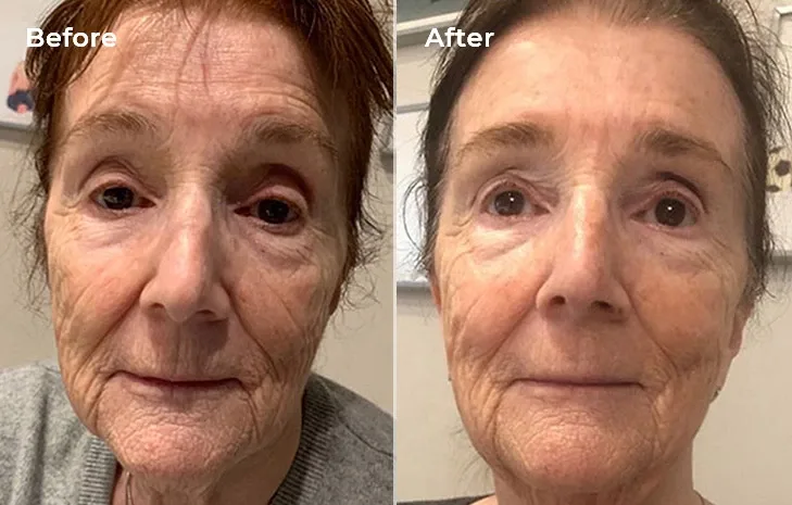 Before and after photo of wrinkled skin on face