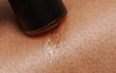 The Best Laser Scar Removal Treatment at Home.