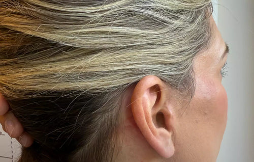 How the LYMA Laser Helped Improve the Appearance of My Heart Surgery Scar