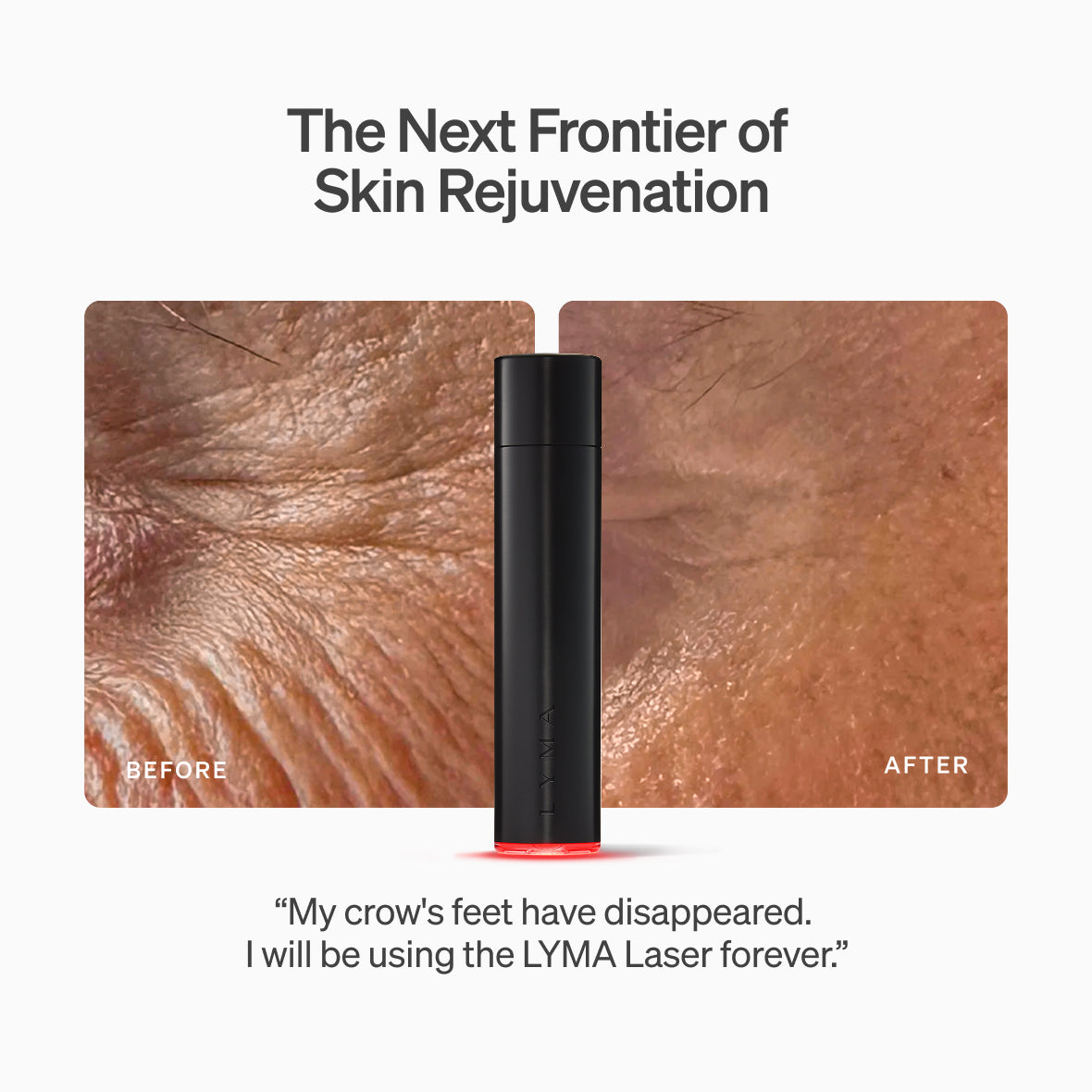 The LYMA Youth System Longevity Edition - Tighter jawline. Fewer wrinkles. Firmer neck. This is what happens when three technologies are engineered as one anti-ageing system.