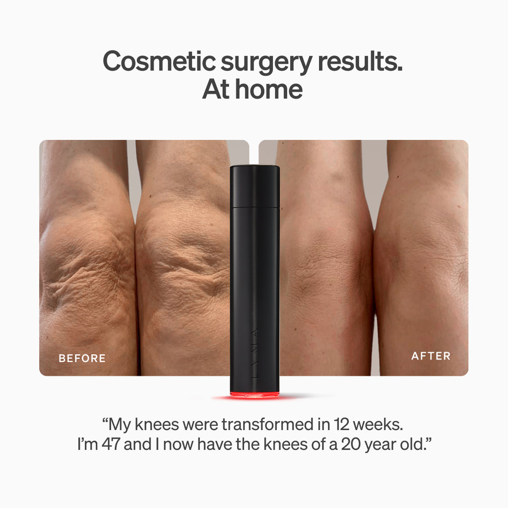 20% off the LYMA Laser