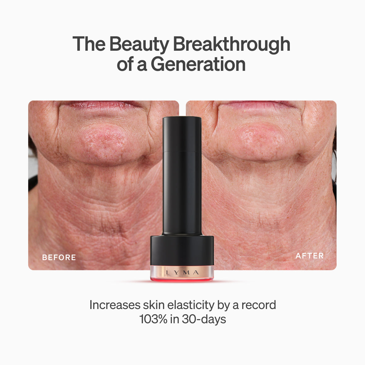 LYMA PRO Youth System - The unrivalled power of the LYMA Laser x3. Delivers cosmetic surgery results to transform face, neck and full body