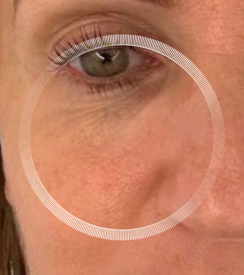 LYMA Laser - LYMA's breakthrough cold laser technology. Engineered to make you look younger.