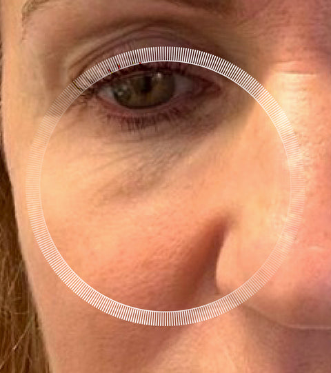 LYMA Laser - LYMA's breakthrough cold laser technology. Engineered to make you look younger.