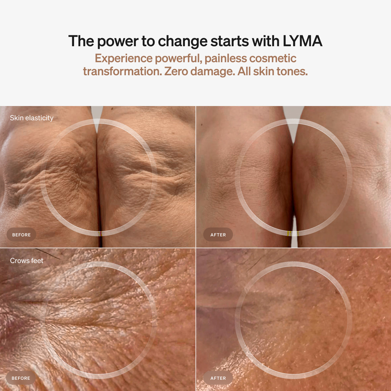 LYMA Laser